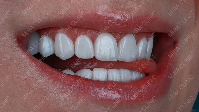 Composite Veneers